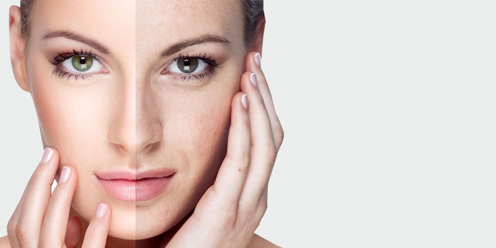 Rejuvenecimiento facial